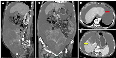 Case Report: Severe Rashes Associated With Fruquintinib in a Patient With Metastatic Colorectal Cancer